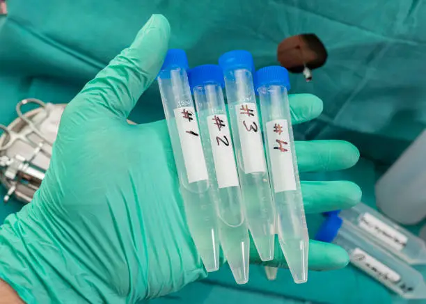 Photo of Vials with four samples of cerebrospinal fluid in patients with transverse myelitis after being injected with an experimental Oxford covid-19 vaccine, conceptual image