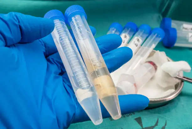 Photo of Vials with samples of cerebrospinal fluid in patients with transverse myelitis after being injected with experimental Oxford covid-19 vaccine, on the left vial with perfect fluid, on the right vial with fluid in poor condition, conceptual image