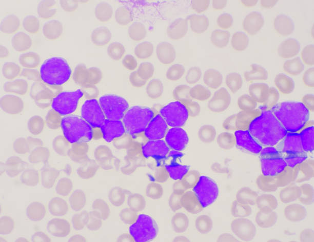 혈액 얼룩 배경. - leukemia pathologist blood hematologist 뉴스 사진 이미지