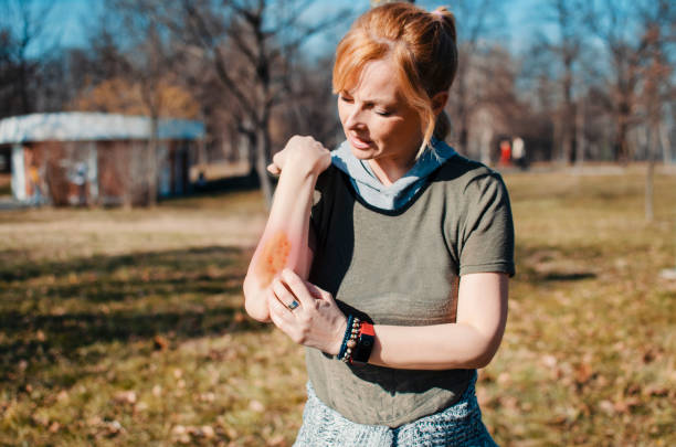 Woman scratching arm outdoors Women scratch the itch with hand. Winterizing dry itchy skin on the elbow area. Psoriasis and Eczema dermatologic diseases. dermatitis photos stock pictures, royalty-free photos & images