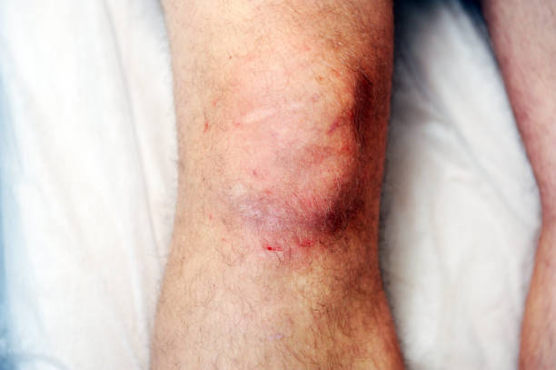 istock Reddened skin on the knee after carbon dioxide therapy (carboxytherapy) 1276971526