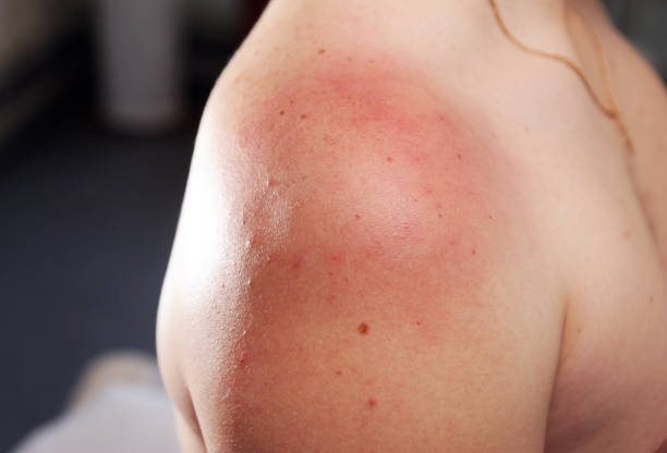 istock Reddened skin on the shoulder after carbon dioxide therapy (carboxytherapy) 1276971551