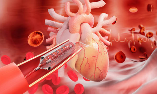 istock Stent implantation for heart coronary with blood cell background.  3d render. 1276975707