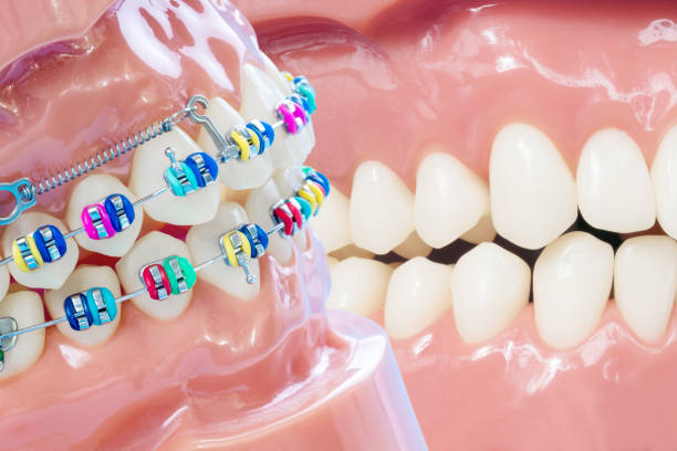 istock Close up dentist tools and orthodontic model. 1277054265