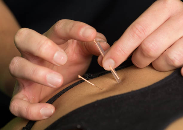 istock A close up image of a patient getting acupuncture 1277071654