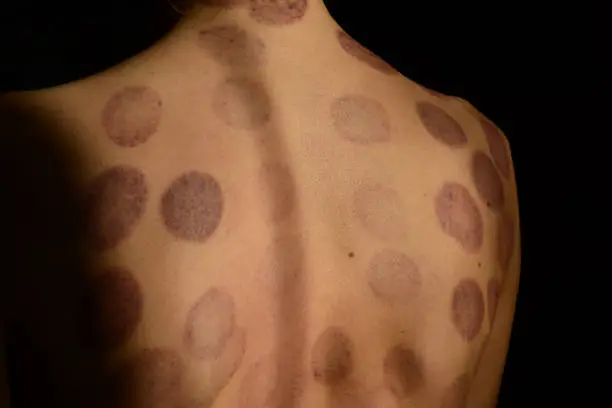 Cupping traces, round bruises on skin of a woman's back after applying Chinese medicine vacuum cupping therapy, deep-tissue massage.