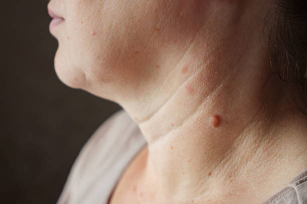 Close-up of a mole on a woman's neck Close-up of a mole on a woman's neck. wart stock pictures, royalty-free photos & images
