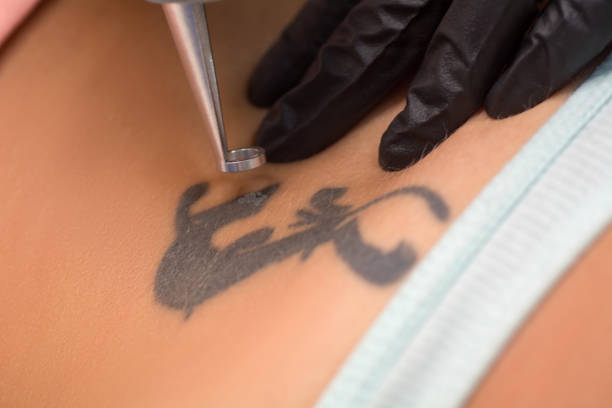 procedimento de remoção da tatuagem a laser. equipamento de salão - tattoo - fotografias e filmes do acervo