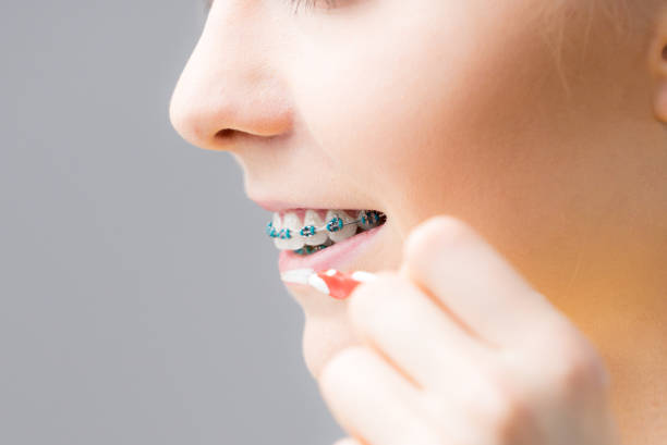 istock Woman smiling cleaning teeth with braces 1277279717