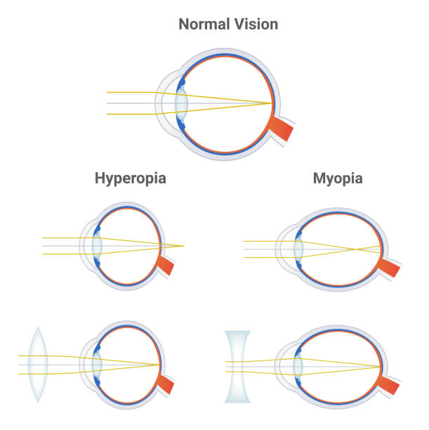 Myopia, hyperopia and normal vision. Common vision disorders. Short sightedness, far sightedness and corrected eye by plus positive lens and minus negative lens. Icons with focusing of light isolated. Myopia, short-sightedness or nearsightedness eye disorder, and corrected eye by a minus lens or biconcave negative lens. Hyperopia, farsightedness eye disorder and corrected eye by a plus lens or biconvex positive lens and normal vision – anatomy of healthy eye ball without disorder. Scientific illustrations are isolated on a white background. myopia stock illustrations