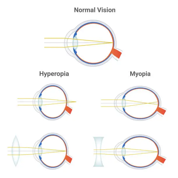 Vector illustration of Myopia, hyperopia and normal vision. Common vision disorders. Short sightedness, far sightedness and corrected eye by plus positive lens and minus negative lens. Icons with focusing of light isolated.