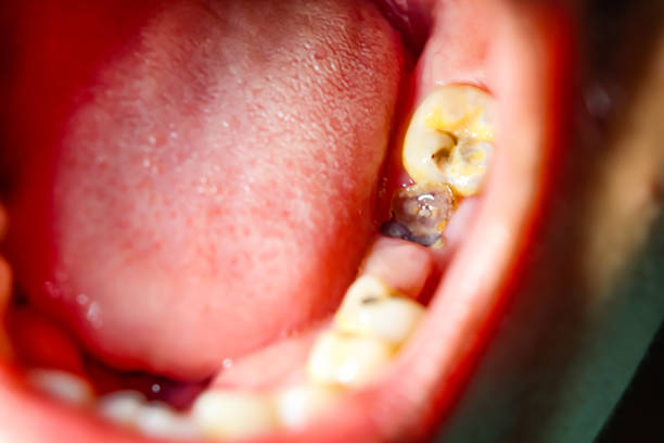 cavities and broken teeth - dentist child dentist office human teeth imagens e fotografias de stock