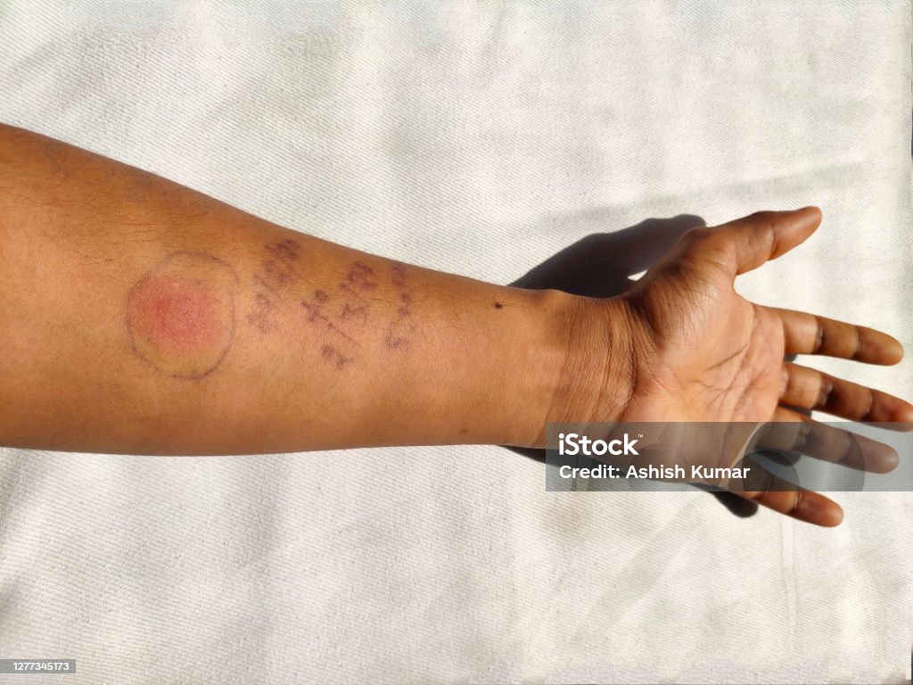 TB skin test is also called the Mantoux tuberculin skin test ,TST arm with red spot reaction to conducting Mantoux test after 72 hours from injection. indian man arm on hospital bed. Tuberculosis Bacterium Stock Photo