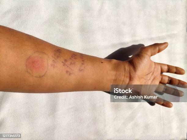 Tb Skin Test Is Also Called The Mantoux Tuberculin Skin Test Tst Stock Photo - Download Image Now