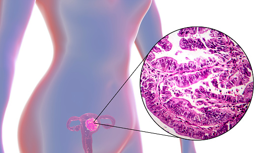 Uterine cancer, 3D illustration and light micrograph showing malignant tumor in the female uterus