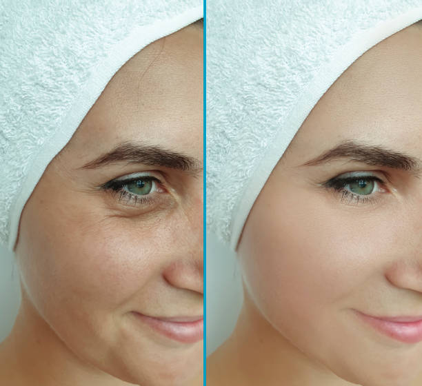 người phụ nữ phải đối mặt với nếp nhăn trước và sau khi điều trị cắt dán - thắt chặt bức ảnh hình ảnh sẵn có, bức ảnh & hình ảnh trả phí bản quyền một lần