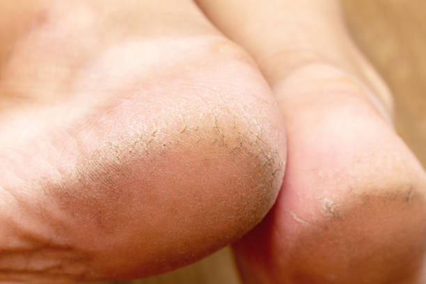 istock Corn callus cracks on a sole heel foot close up. Dry skin dermatology problem. 1277406489