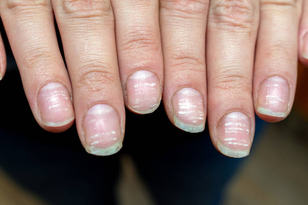 1,958 White Spots On Nails Stock Photos, Pictures & Royalty-Free Images - iStock | Nail fungus 1,958 White Spots On Nails Stock Photos, Pictures & Royalty-Free Images - iStock | Nail fungus