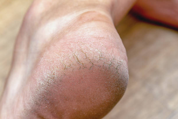 istock Corn callus cracks on a sole heel foot close up. Dry skin dermatology problem. 1277406498