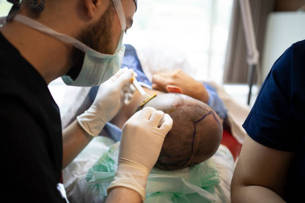 istock Hair transplant 1277528859