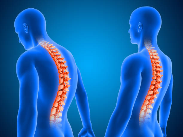 istock 3D medical background showing correct and poor posture with spine highlighted 1277536304