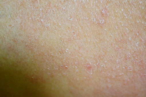 Close-up allergic rash dermatitis eczema skin of patient background