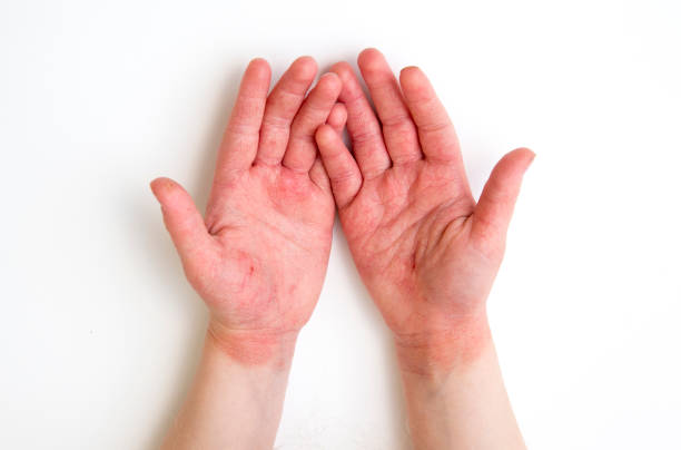 4-летний ребенок красный опухшие трещины атопический дерматит руки, вызванные много мытья рук и дезинфицирующих средств для рук во время ко - dermatitis dry human hand human skin стоковые фото и изображения