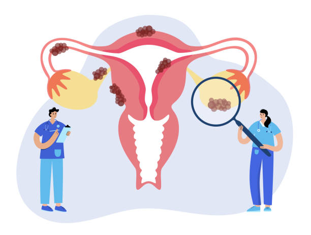Gynecology clinic concept Uterus anatomy, endometriosis. Cancer and tumor disease. Woman health medicine. Doctor gynecologist appointment, consultation, help, treatment. Female reproductive system flat vector illustration endometriosis stock illustrations