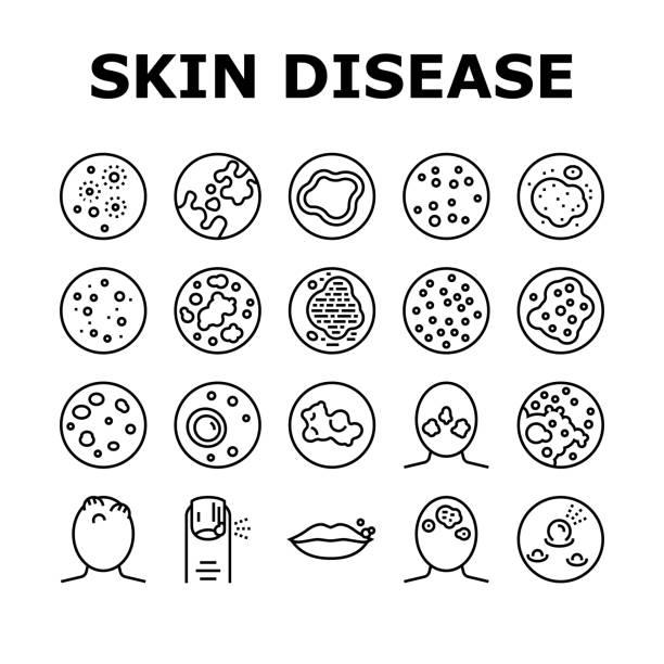 illustrations, cliparts, dessins animés et icônes de icônes de la collection de symptômes de maladies de la peau définir vecteur - psoriasis