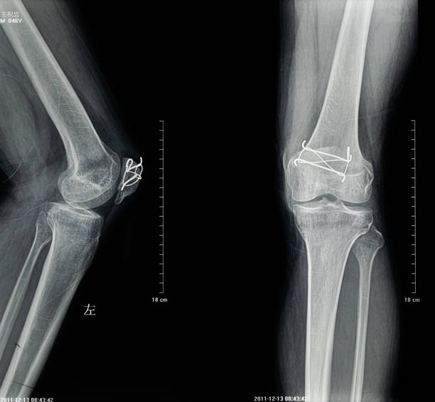istock Human Leg X-Ray Close-up 1278054313