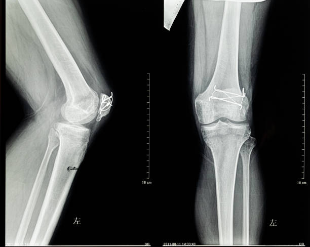 istock Human Leg X-Ray Close-up 1278196852