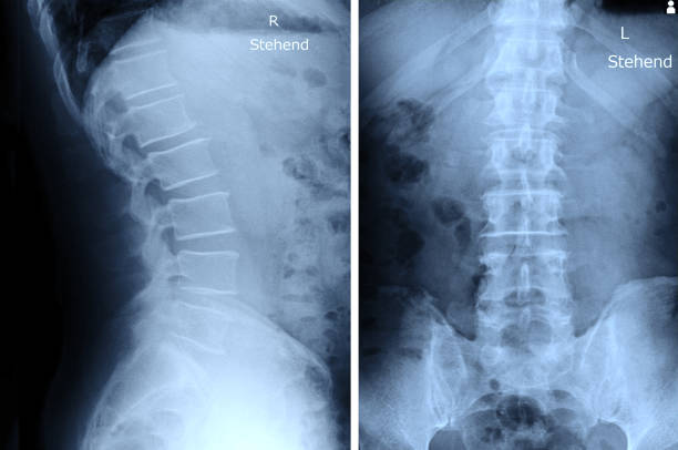 obraz rentgenowski kręgów lędźwiowych - paralysis human spine x ray image human bone zdjęcia i obrazy z banku zdjęć