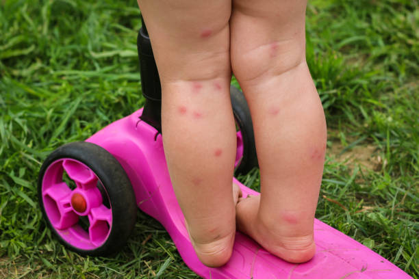 The baby's Legs are on a pink Scooter on a green Grass. The baby's Legs are on a pink Scooter on a green Grass. Insect Bites on the baby's Legs. bug bite photos stock pictures, royalty-free photos & images