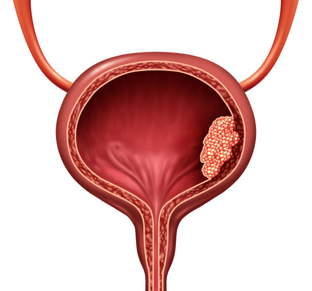 Human Bladder Cancer Human bladder cancer as a urinary anatomical organ disease and malignant cells concept as a 3D illustration cutaway of body anatomy. bladder stock pictures, royalty-free photos & images