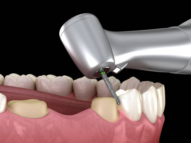 istock Premolar preparation process for dental crown placement. Medically accurate 3D illustration 1278530481