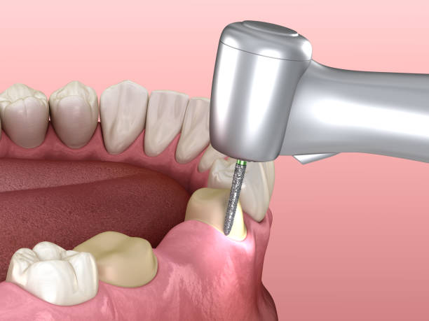 istock Premolar preparation process for dental crown placement. Medically accurate 3D illustration 1278530485