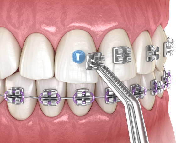 istock Metal braces installation process. Medically accurate dental 3D illustration 1278530527