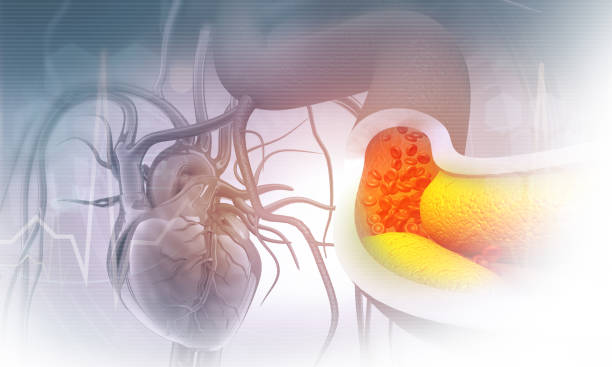 istock Human heart with clogged artery 1278538994