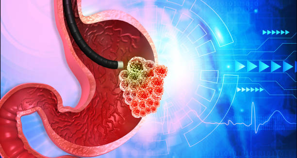 istock Stomach cancer, treatment 1278547423