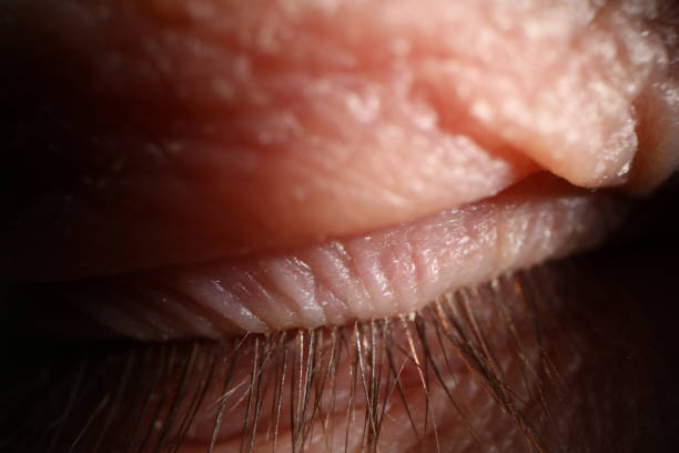 Close up of sleeping person with long eyelashes and eyelid disease