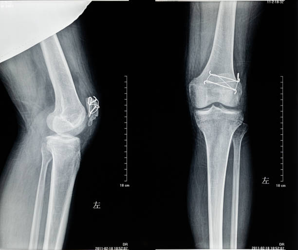 istock Human Leg and Knee X-Ray Close-up 1278589600