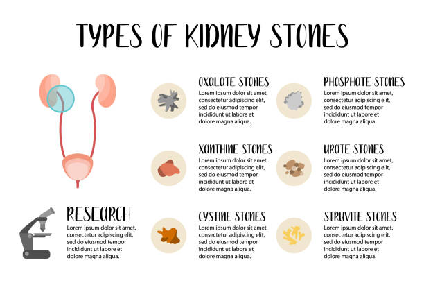 ilustrações, clipart, desenhos animados e ícones de tipos de pedras nos rins. oxalato, fosfato, xanthine, úato, cistina, pedras de struvite. doença de urolithiase. doença renal e bexiga. ilustração plana vetorial. perfeito para panfleto, folheto médico - kidney stone