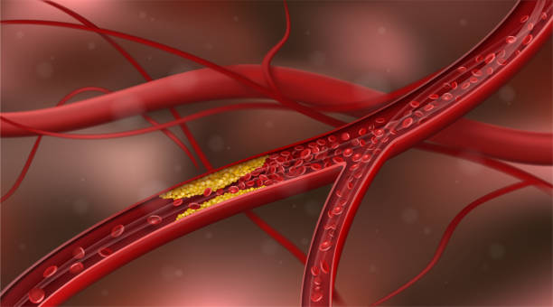 Artery blocked by cholesterol. Vector illustration Artery blocked by cholesterol. Vector illustration clogged artery stock illustrations