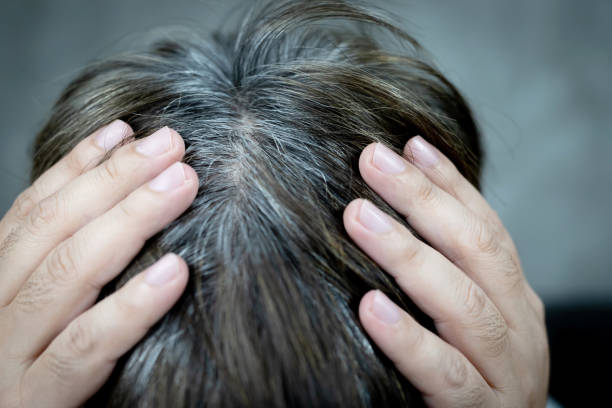 istock A man has hair growth, he has hair loss problems. Dry scalp, dandruff 1278802169