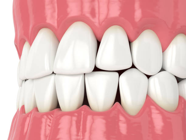 istock 3d render of human jaw with black triangles 1278802697
