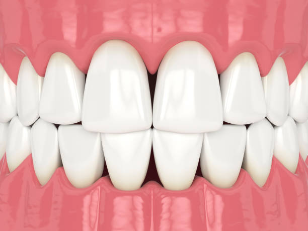 istock 3d render of human jaw with black triangles 1278802700