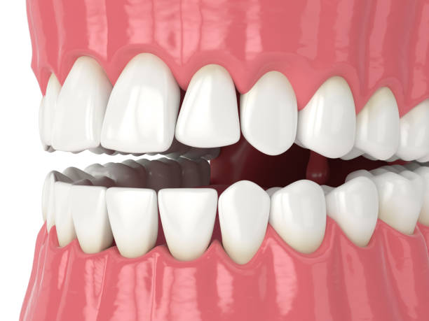 istock 3d render of human jaw with black triangles 1278802717