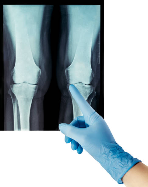 рентгеновские ревматические заболевания и ревматоидный артрит коленного сустава рука об руку в перчатке - rheumatic стоковые фото и изображения