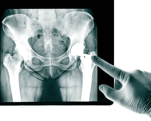 X-ray of the pelvis Endoprosthesis X-ray of the pelvis Endoprosthesis, the socket of the hip joint used for Hip Joint rheumatic diseases and Rheumatoid Arthritis hip replacement stock pictures, royalty-free photos & images