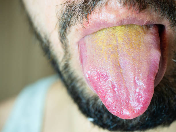 männlicher mund mit einer hervorstehenden zunge mit einer gelben beschichtung an der basis - menschliche zunge stock-fotos und bilder